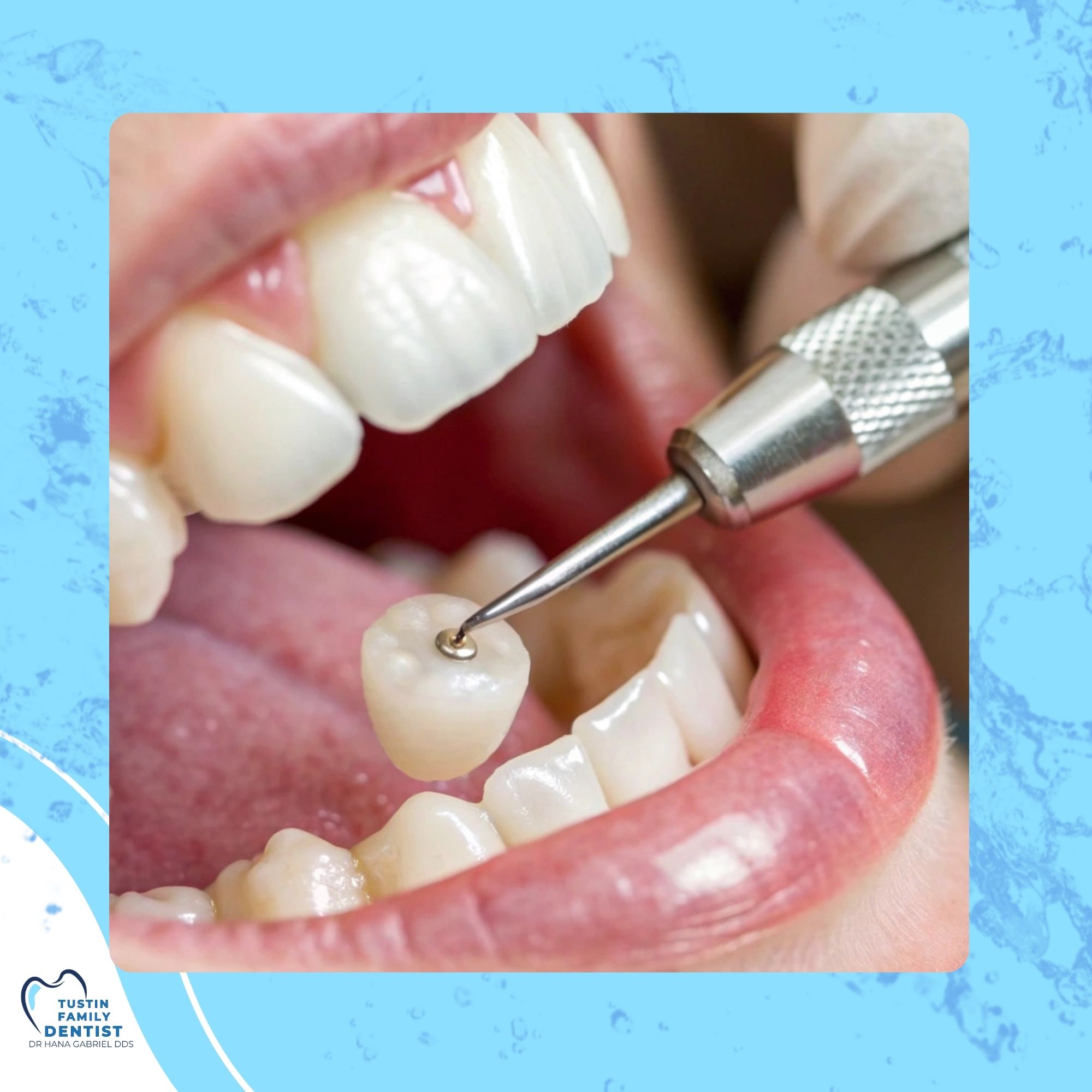 Illustrated crown imagery highlighting crowns, bridges, and dentures