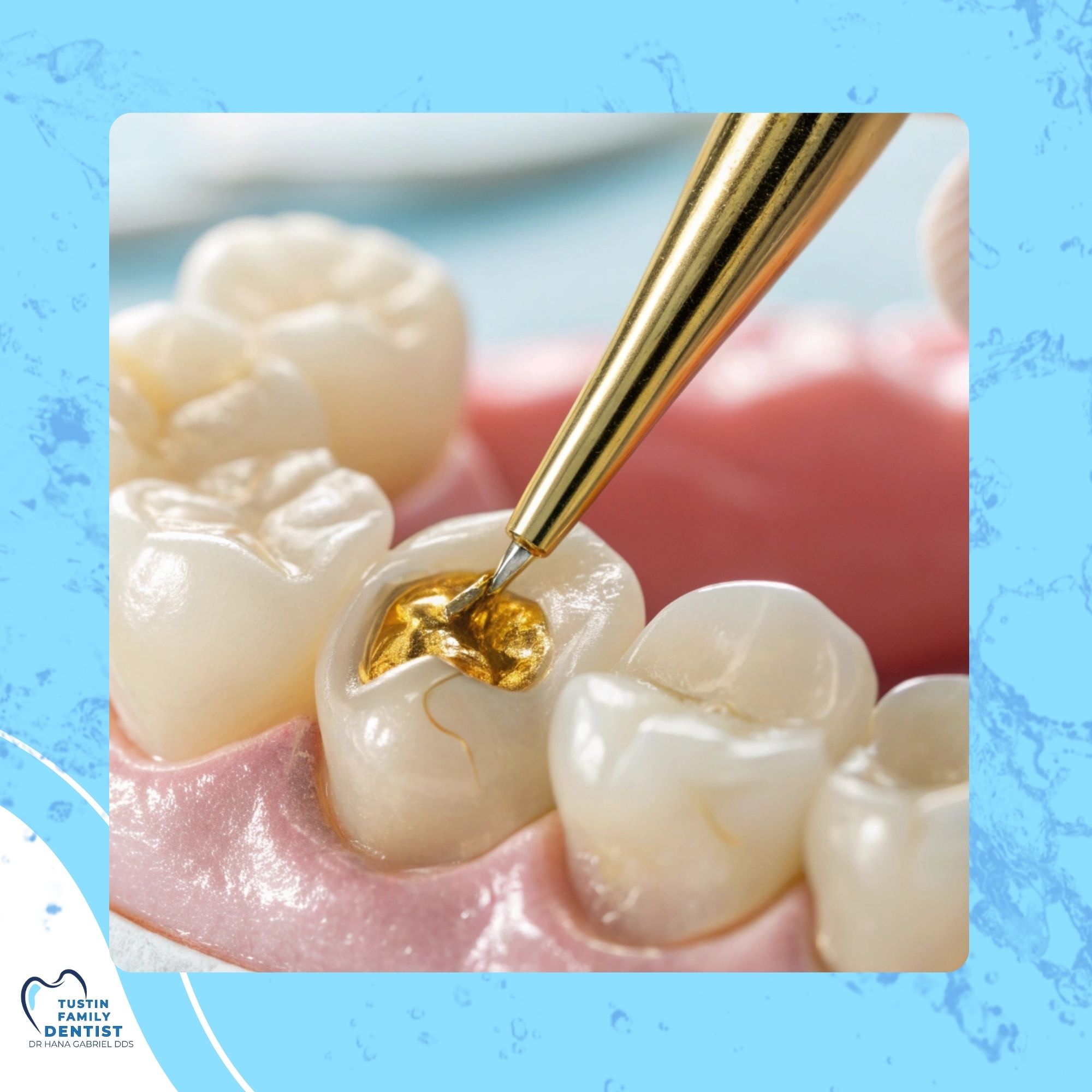 Illustrated filled tooth representing dental restorations