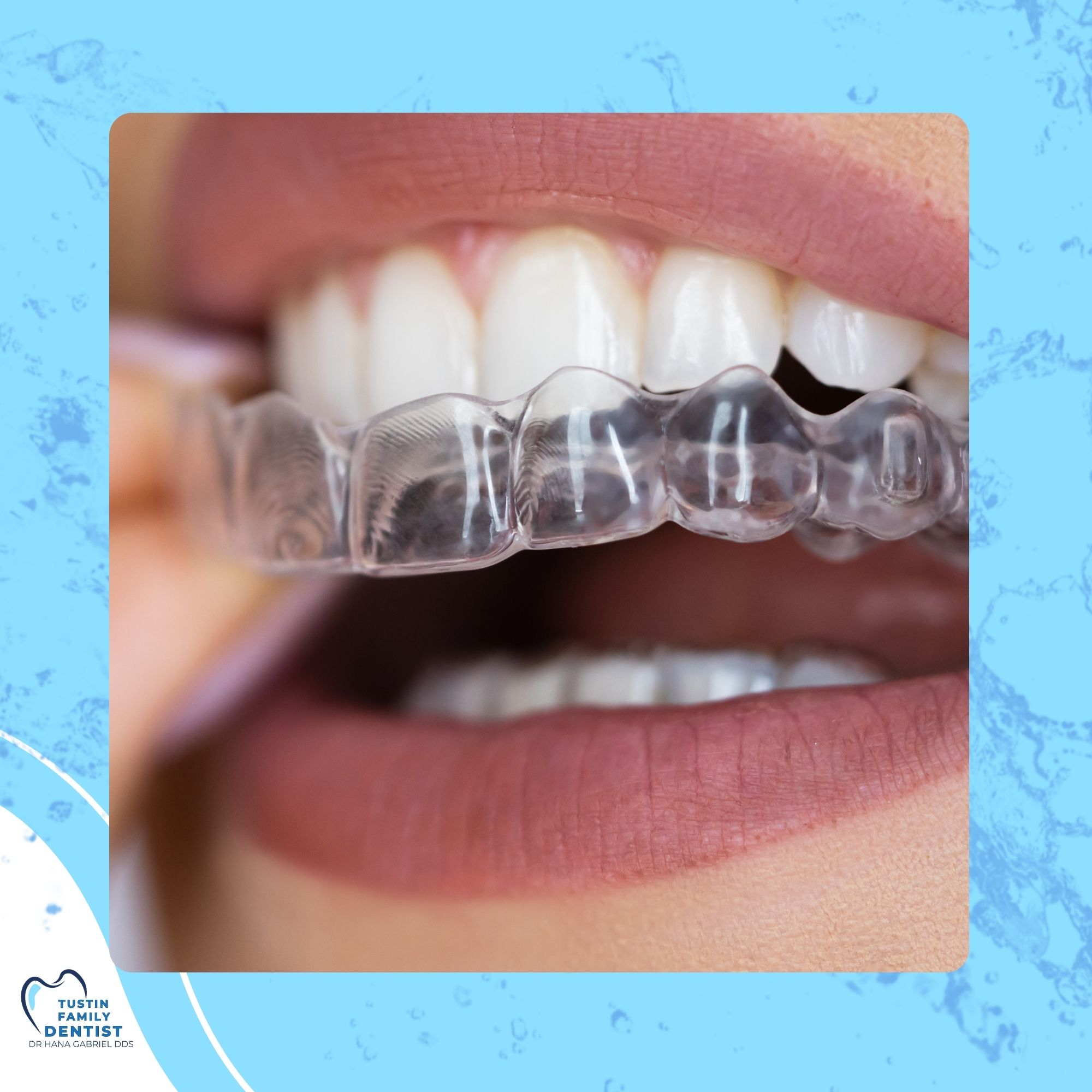 Custom mouthguards and periodontal therapy equipment for dental protection and gum health
