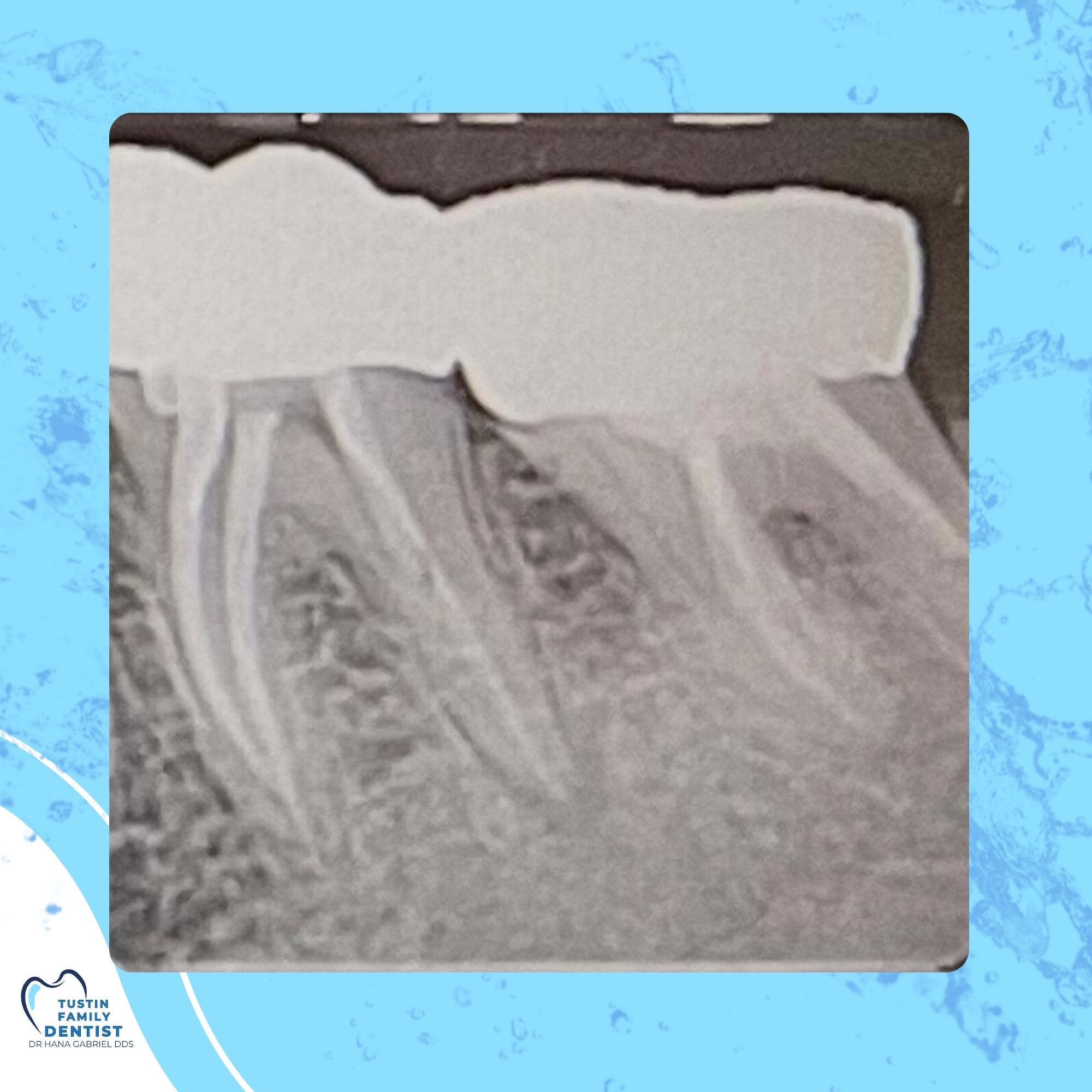 Illustrated endodontic instrument representing root canal therapy
