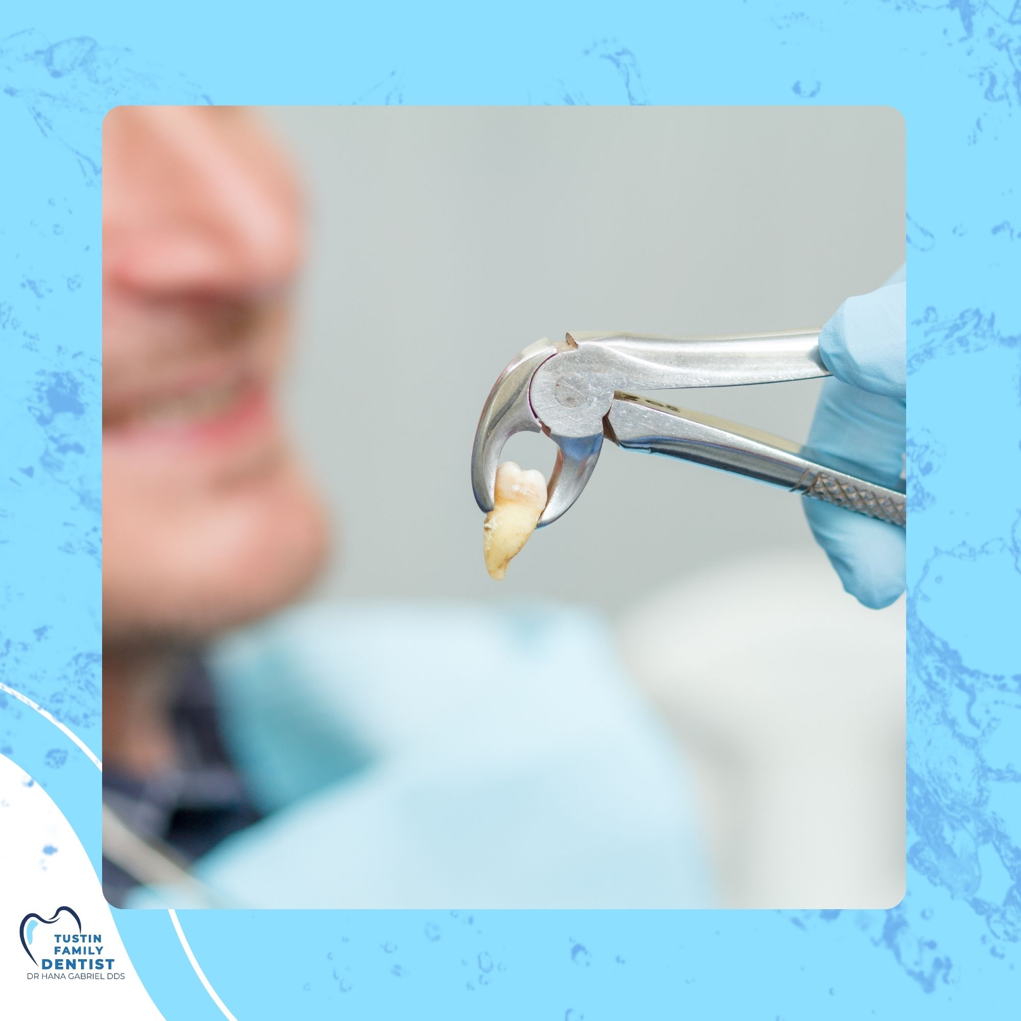 Illustrated forceps design representing gentle tooth extractions