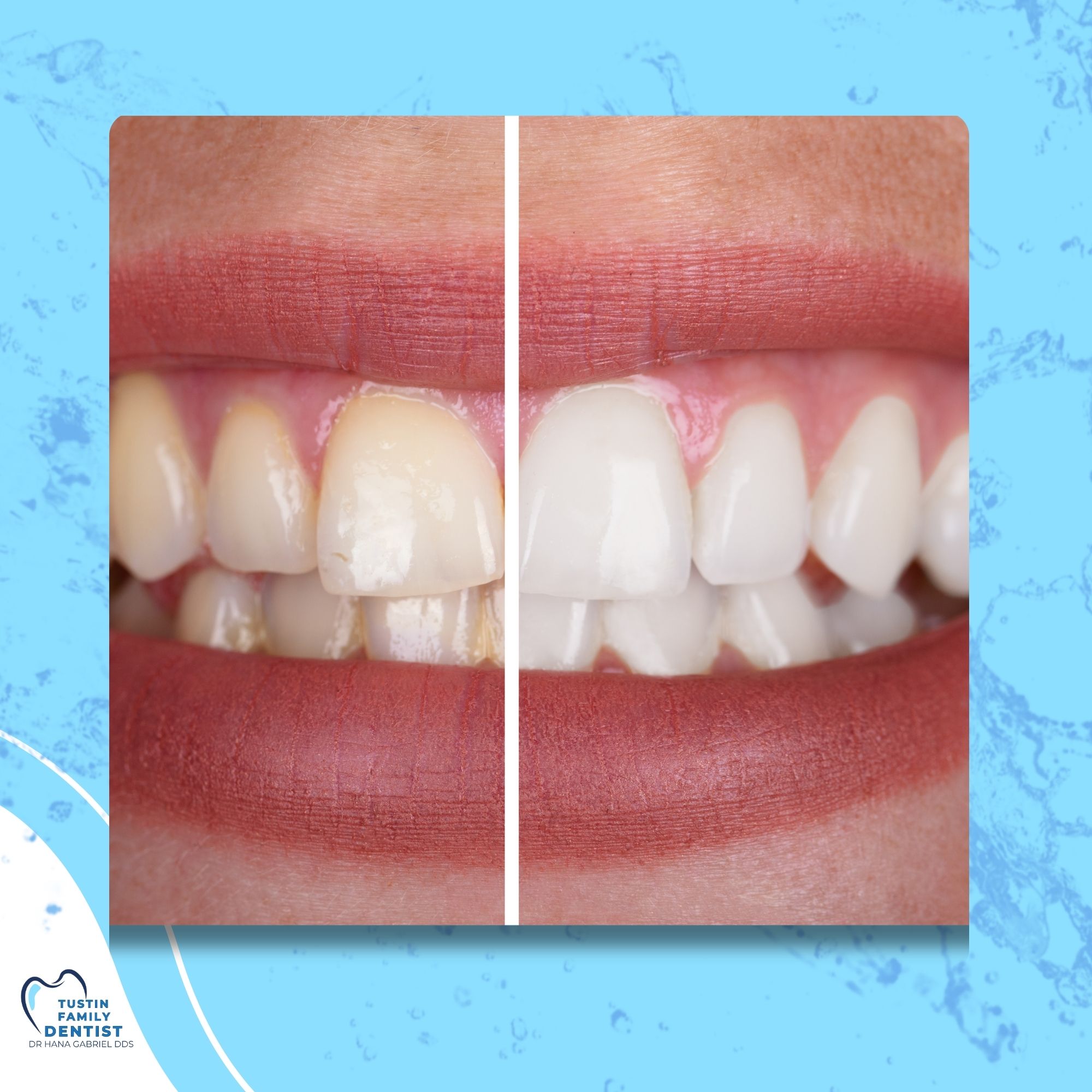 Illustrated sparkling tooth representing teeth whitening and bonding