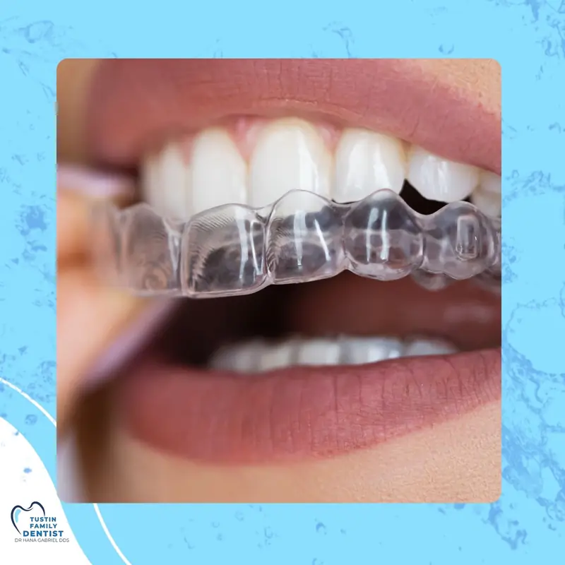 Custom mouthguards and periodontal therapy equipment for dental protection and gum health